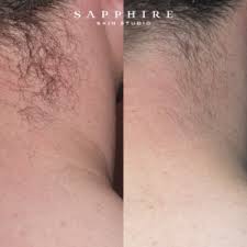Lip $60 or 5 prepaid for $220 underarms $70 or 4 prepaid for $200 half arms $150. Ipl Hair Reduction Sapphire Skin Studio Midland Perth