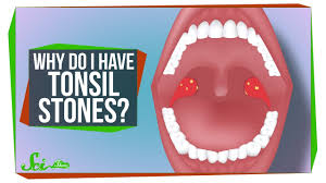 Once you get rid of your mucus and post nasal drip, your tonsil stones will go away automatically. Why Do I Have Tonsil Stones Youtube