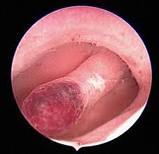 Chapter 6 Endometrial Polyps Melaka Fertility