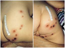 Staph infections, including mrsa infections, may appear as boils or abscesses, with pus or drainage present. Impetigo Ecthyma Treatment Symptoms Causes Manuals Dermatologic Disorders Msd Manual Professional Edition