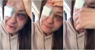 242,538 likes · 3,607 talking about this. Ufc Fighter Karolina Kowalkiewicz Shares Broken Eye Socket Picture After Brutal Kick To Face Daily Star