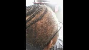 Sew In Weave For Alopecia And Thinning Alopecia Sew In Weave Weave Hairstyles