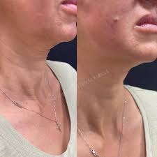 Pdo matrix neck & body. Browse Our Before And After Gallery Dr Pamela Kulback