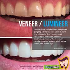 Veneer gigi adalah prosedur medis untuk memperbaiki struktur gigi dengan memasang lapisan buatan atau cangkang di atas permukaan gigi dengan tujuan untuk menutupi kecacatan pada gigi. Rekomendasi Veneer Gigi Oleh Dokter Gigi Di Jakarta Pusat 081294709763 Jasa Optimasi Klinik Dan Praktek Dokter Gigi
