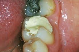 That said, he also said i was very lucky, and that many cavities become big problems within a year or less. White Fillings For Back Teeth The Old Surgery Dental Practice Crewe