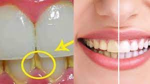 Cara menghilangkan karang gigi yang paling efektif. 5 Menit Hapus Plak Secara Alami Praktis Cara Menghilangkan Karang Gigi Dan Memutihkan Gigi Tribun Jambi