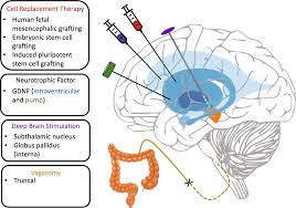 Image result for Pallidotomy