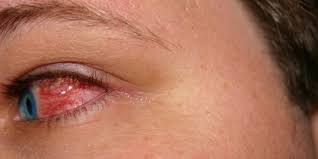 Check spelling or type a new query. 7 Penyebab Mata Merah Sebelah Gejala Dan Cara Mengobatinya Merdeka Com