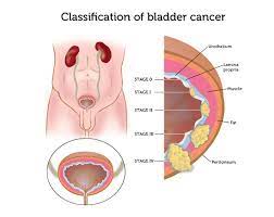 The most common early sign of bladder cancer is hematuria, or blood in the urine. How We Diagnose Bladder Cancer Dana Farber Cancer Institute Boston Ma