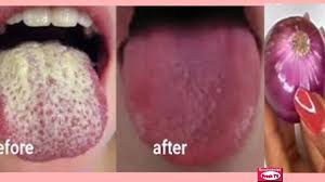 You may be able to remove the white coating from your tongue by gently brushing it with a soft toothbrush. How To Get Rid Of White Tongue And Bad Breath Instantly How To Get A Pink Tongue Fast 100 Works Youtube