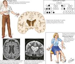 Image result for Chorea