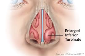 Sleep apnea surgery