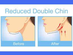 Cut down on your salt intake since too much sodium leads to water retention. 7 Easy Exercises To Get Rid Of A Double Chin Femina In