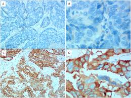 Immunohistochemical Staining Of Ttf 1 Expression In Non Small Cell Lung Download Scientific Diagram
