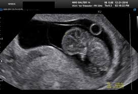 For a vaginal scan, you can have an empty bladder. Diagnostic Ultrasound In The First Trimester Of Pregnancy Glowm