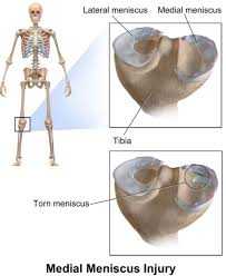 We did not find results for: Meniscus Tear Settlements Car Accidents Slip And Falls And More