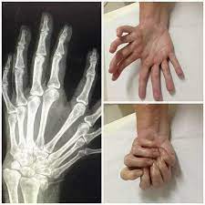 The name mirror syndrome refers to the similarity between maternal edema and fetal hydrops. A Case Of Congenital Mirror Hand Syndrome Pics