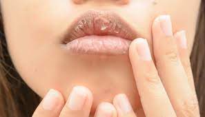 Oleh karena itu, bila kamu ingin mengatasi bibir yang hitam mulailah terlebih dahulu untuk mengurangi kebiasaan merokok ataupun mengonsumsi kafein secara berlebih. Kenapa Bibir Perokok Selalunya Hitam Ini Punca Dan Cara Merawatnya