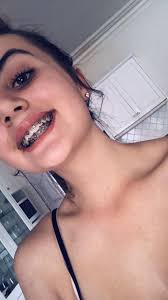 Black And Pink Braces Pin On Cute Funny Random Posts