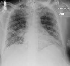 Image result for Cor Pulmonale