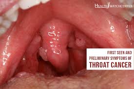 Download this image for free in hd resolution the choice download button below. Hpv Related Throat Cancer Symptoms Celine Dion Songs Age