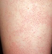 How To Get Rid Of Bumps On Arms Patchy Skin Red Patchy Skin Skin Bumps On Arms
