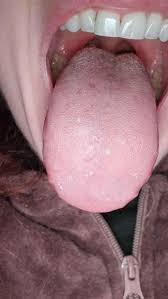 Image result for Puchýře na jazyku