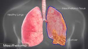 This is known as palliative or supportive care. Mesothelioma Symptoms Causes And Treatment Scientific Animations