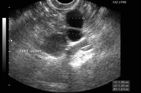 Of the various imaging methods that have been evaluated for use in ovarian cancer screening, transvaginal ultrasound has consistently proven to be the most effective technique. Ovarian Cancer Screening Cmaj