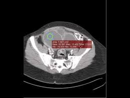 Endometriosis of the rectus abdominis muscle is a very rare event and it should be kept in mind in the differential diagnosis of women with abdominal wall mass. Ct Large Endometriomas On Ct Pelvis Discussion By Radiologist Youtube