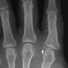 I found out that i broke it 8 weeks after i did it. Fractures And Dislocations Of The Fingers Chapter 1 Broken Bones