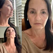 Has anyone used Attiva laser treatment for sagging eyes?