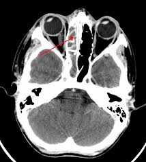 sinusitis wikipedia