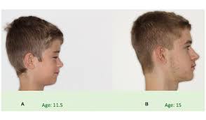 Will My Child'S Jaw Grow? - Youtube