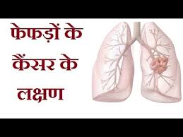 You may not notice any symptoms of lung cancer ― many people don't. à¤« à¤«à¤¡ à¤• à¤• à¤¸à¤° à¤• à¤²à¤• à¤·à¤£ Symptoms Of Lung Cancer In Hindi Youtube