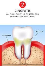 When gum recession occurs, spaces between the gums and teeth are created that allow harmful bacteria and plaque to. Gum Disease 101 What You Don T Know Can Kill You Millennium Dental Technologies Inc