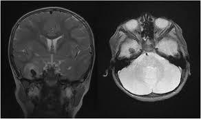Herpes simplex virus infections of the central nervous system: Decompressive Craniectomy In Case Of Herpes Encephalitis Springerlink