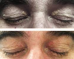 Cosmetic surgery, laser treatment, cryotherapy, and chemical cauterization can remove these unsightly cholesterol. Xanthelasma Before After
