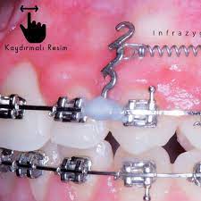 takip etmeyi unutmayin ortodontist fatih kahraman klinigimde cenede yer ihtiyaci olan pek cok vakada yer kazanmak icin dis cekimine gerek duymaya
