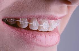 Usually, such overgrowth of gum tissues also subsides within 6 to 8 weeks after the braces are removed. What To Know About Getting Braces On Your Teeth After 50