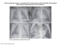 Lch is called a cystic disease. Chest Radiograph Images Ppt Download
