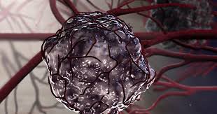 If you think you might have a bone tumor, see your doctor as soon as possible for diagnosis and treatment. What S The Difference Benign And Malignant Tumors Ctca