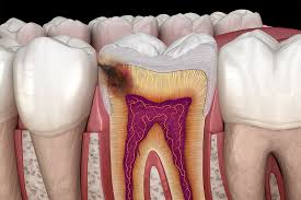 Image result for Tooth Extraction