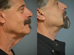 Facial Plastic Surgery in Philadelphia, PA