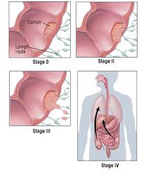 Signs and symptoms of rectal cancer include: Colorectal Cancer Guide Causes Symptoms And Treatment Options