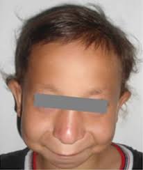 Vista de Caracterización del fenotipo clínico y conductual del síndrome  tricorrinofalángico tipo I. Informe de caso