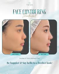 Take a look at how natural & pretty @evelinatan73 face contouring results  🥰 Curious? Consult with us now! #ToscaClinic Be the best version of your  unique self. Phone: 021 769 1906 www.toscaclinic.com #