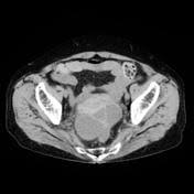 Treatment options include surgery and hormones. Endometriosis Ct Scan Radiopaedia Ct Scan Machine
