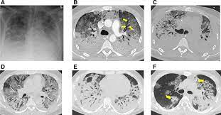 It was first identified in december 2019 in wuhan,. Respiratory Follow Up Of Patients With Covid 19 Pneumonia Thorax