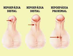 But some boys are born with a common condition called hypospadias. Hipospadias Cuales Son Las Causas Dr Boris Camacho Molina Urologo La Paz Bolivia